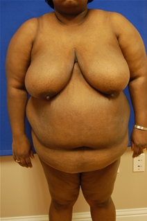 Breast Reduction Before Photo by Randy Proffitt, MD; Mobile, AL - Case 21852