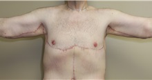 Arm Lift After Photo by Meegan Gruber, MD, PhD; Tampa, FL - Case 29920