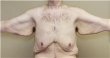 Arm Lift Before Photo by Meegan Gruber, MD, PhD; Tampa, FL - Case 29920