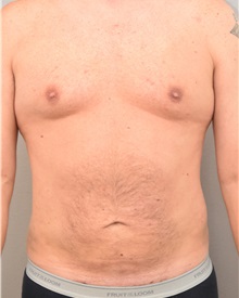 Liposuction After Photo by Keshav Magge, MD; Bethesda, MD - Case 31693
