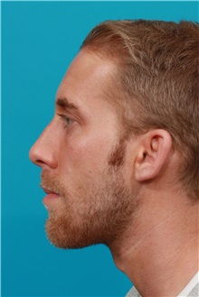 Chin Augmentation After Photo by Michael Bogdan, MD, MBA, FACS; Grapevine, TX - Case 31852