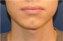 Chin Augmentation Before Photo by Richard Reish, MD, FACS; New York, NY - Case 32838