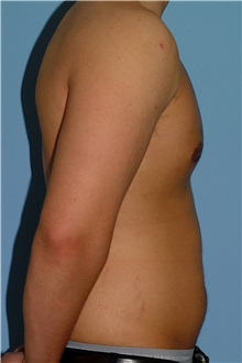 Male Breast Reduction After Photo by Paul Vanek, MD, FACS; Concord, OH - Case 34036