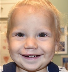 Cleft Lip and Palate Repair After Photo by Rachel Ruotolo, MD; Garden City, NY - Case 34079