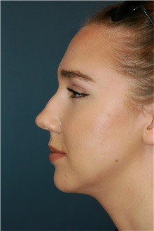 Rhinoplasty Before Photo by Steve Laverson, MD, FACS; Rancho Santa Fe, CA - Case 36810