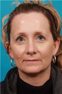 Brow Lift Before Photo by Michael Bogdan, MD, MBA, FACS; Grapevine, TX - Case 36906