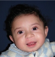 Cleft Lip and Palate Repair After Photo by Rachel Ruotolo, MD; Garden City, NY - Case 37791