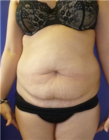 Tummy Tuck Before Photo by Mark Markarian, MD, MSPH, FACS; Wellesley, MA - Case 38055
