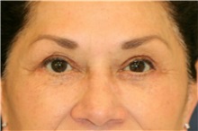 Eyelid Surgery After Photo by Steve Laverson, MD, FACS; Rancho Santa Fe, CA - Case 38178