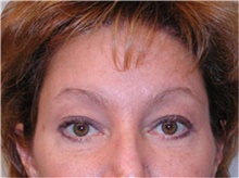 Brow Lift After Photo by Mariam Awada, MD, FACS; Southfield, MI - Case 38882