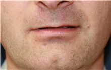 Lip Augmentation/Enhancement Before Photo by Steve Laverson, MD, FACS; Rancho Santa Fe, CA - Case 39035