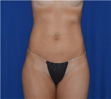 Liposuction After Photo by Karol Gutowski, MD, FACS; Glenview, IL - Case 39220