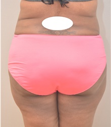 Buttock Lift with Augmentation After Photo by Keshav Magge, MD; Bethesda, MD - Case 39352