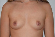 Breast Augmentation Before Photo by David Rapaport, MD; New York, NY - Case 40462