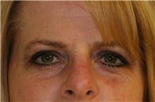 Brow Lift Before Photo by Steve Laverson, MD, FACS; Rancho Santa Fe, CA - Case 40970