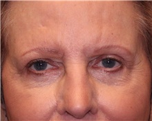 Eyelid Surgery After Photo by Jennifer Greer, MD; Mentor, OH - Case 41077