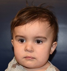 Cleft Lip and Palate Repair After Photo by Rachel Ruotolo, MD; Garden City, NY - Case 41376