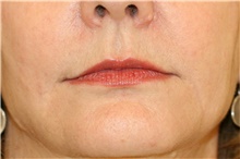 Lip Augmentation/Enhancement After Photo by Steve Laverson, MD, FACS; Rancho Santa Fe, CA - Case 41513
