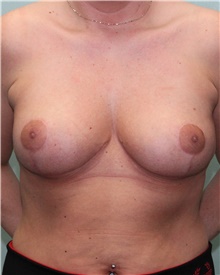 Breast Reduction After Photo by Jennifer Greer, MD; Mentor, OH - Case 41656
