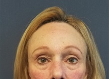 Eyelid Surgery Before Photo by Noel Natoli, MD, FACS; East Hills, NY - Case 41897