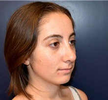 Rhinoplasty After Photo by Rachel Ruotolo, MD; Garden City, NY - Case 41963