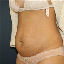 Tummy Tuck Before Photo by Steve Laverson, MD, FACS; Rancho Santa Fe, CA - Case 42452
