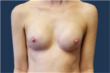 Breast Reconstruction After Photo by Noel Natoli, MD, FACS; East Hills, NY - Case 43330
