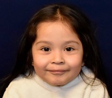 Cleft Lip and Palate Repair After Photo by Rachel Ruotolo, MD; Garden City, NY - Case 43390
