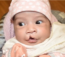 Cleft Lip and Palate Repair Before Photo by Rachel Ruotolo, MD; Garden City, NY - Case 43390