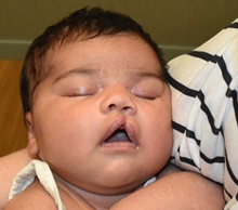 Cleft Lip and Palate Repair Before Photo by Rachel Ruotolo, MD; Garden City, NY - Case 43410