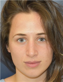 Rhinoplasty Before Photo by Richard Reish, MD, FACS; New York, NY - Case 43525