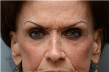 Brow Lift Before Photo by Carlos Rivera-Serrano, MD; Miami Beach, FL - Case 43668