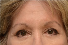 Brow Lift After Photo by Carlos Rivera-Serrano, MD; Miami Beach, FL - Case 43670