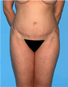 Body Lift Before Photo by Siamak Agha, MD PhD FACS; Newport Beach, CA - Case 43871