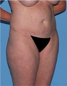 Body Lift Before Photo by Siamak Agha, MD PhD FACS; Newport Beach, CA - Case 43873
