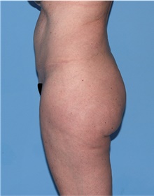 Body Lift Before Photo by Siamak Agha, MD PhD FACS; Newport Beach, CA - Case 43873