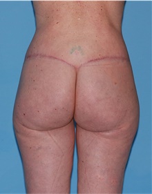 Body Lift After Photo by Siamak Agha, MD PhD FACS; Newport Beach, CA - Case 43873