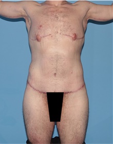 Body Lift After Photo by Siamak Agha, MD PhD FACS; Newport Beach, CA - Case 43940