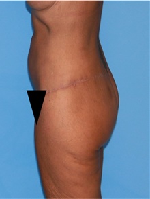 Body Lift After Photo by Siamak Agha, MD PhD FACS; Newport Beach, CA - Case 43949