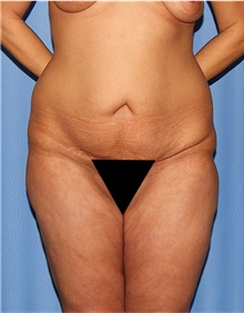 Body Lift Before Photo by Siamak Agha, MD PhD FACS; Newport Beach, CA - Case 43950
