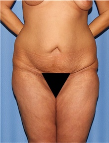 Body Lift Before Photo by Siamak Agha, MD PhD FACS; Newport Beach, CA - Case 43950
