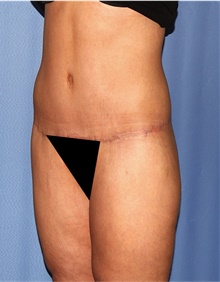 Body Lift After Photo by Siamak Agha, MD PhD FACS; Newport Beach, CA - Case 43950