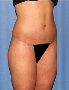Body Lift After Photo by Siamak Agha, MD PhD FACS; Newport Beach, CA - Case 43950