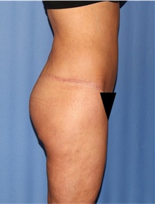 Body Lift After Photo by Siamak Agha, MD PhD FACS; Newport Beach, CA - Case 43950