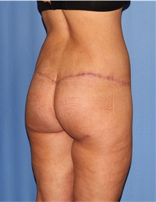 Body Lift After Photo by Siamak Agha, MD PhD FACS; Newport Beach, CA - Case 43950