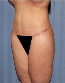 Body Lift After Photo by Siamak Agha, MD PhD FACS; Newport Beach, CA - Case 43983