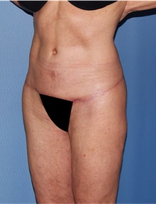 Body Lift After Photo by Siamak Agha, MD PhD FACS; Newport Beach, CA - Case 43989