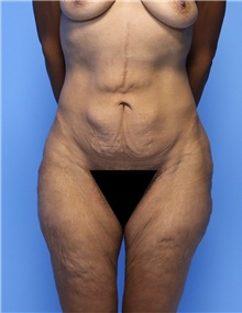 Body Contouring Before Photo by Siamak Agha, MD PhD FACS; Newport Beach, CA - Case 44095