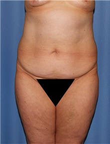 Body Contouring Before Photo by Siamak Agha, MD PhD FACS; Newport Beach, CA - Case 44097