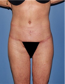 Body Contouring After Photo by Siamak Agha, MD PhD FACS; Newport Beach, CA - Case 44109